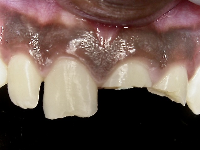 Fractured tooth case